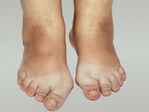 Artrosis del pie con deformación severa de los dedos. 