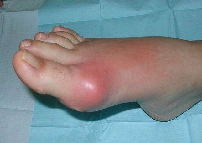 Cuadro clínico de hinchazón e inflamación de la artritis del pie. 