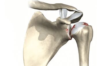 Articulación del hombro afectada por artrosis. 