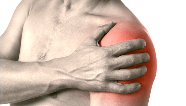 Un hombro hinchado, enrojecido y agrandado síntomas de artrosis de grado 2-3 de la articulación del hombro
