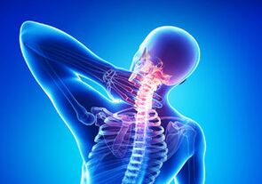 Signos de osteocondosis cervical