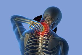 Síntomas de osteocondosis cervical