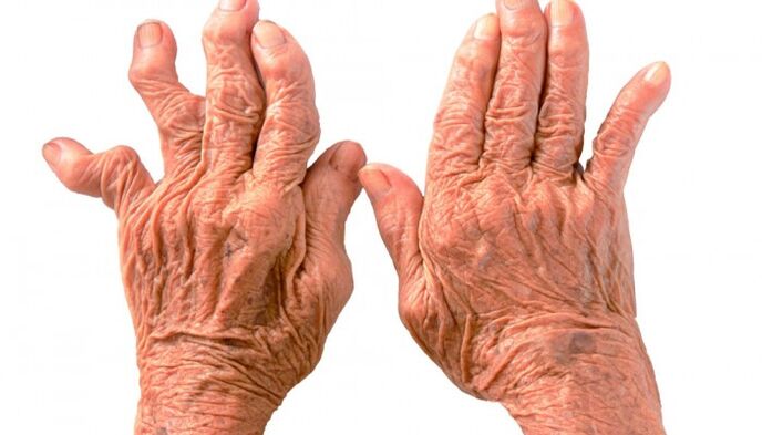 artritis reumatoide como causa de dolor en las articulaciones de los dedos