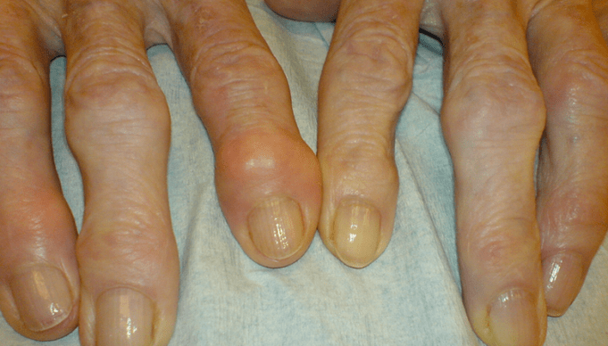 dolor en las articulaciones de los dedos con osteoartritis