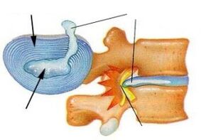 destrucción del anillo fibroso en la osteocondrosis cervical