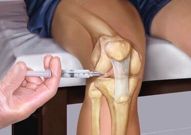 Inyección en la articulación