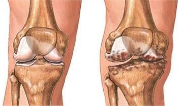 Osteoartritis de la rodilla