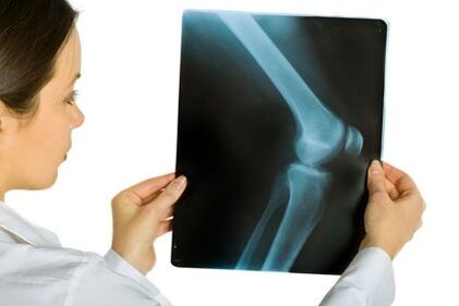 Tratamiento de la artrosis de la articulación de la rodilla