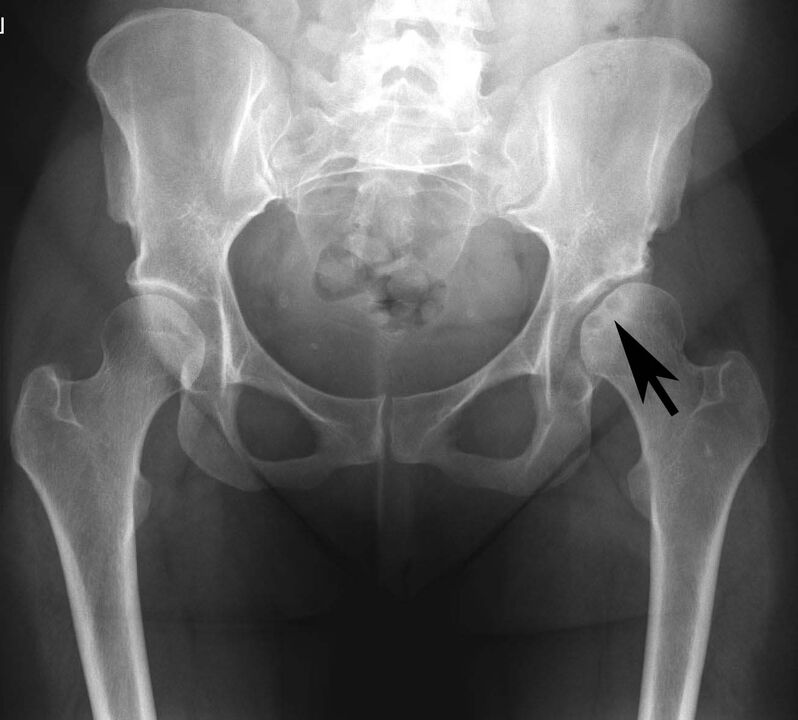 Deposición de sales de calcio en la articulación de la cadera con pseudogota de rayos X