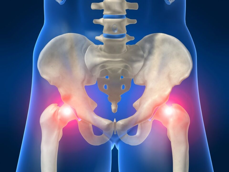 En la espondilitis anquilosante, el dolor bilateral en la articulación de la cadera es molesto. 