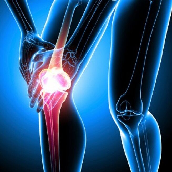La artritis reumatoide avanzada puede causar dolor de cadera