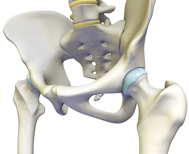 La osteocondrosis causa dolor intenso en la articulación de la cadera. 